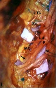 Nesta posição de decúbito ventral, o nervo frênico (C3, C4 e C5) se lateraliza ligeiramente e é facilmente identificado