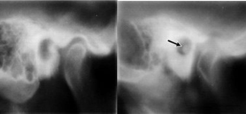 Tomografia convencional Exemplo de imagem obtida com tomografia convencional http://www.radiology-museum.