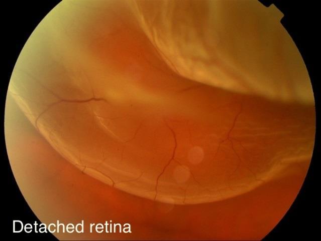 Figura 3. Descolamento de Retina (6). Causas Dependendo da causa, distinguem-se vários tipos de DR.