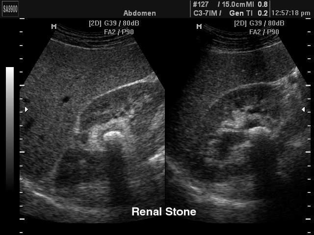 TRATO GENITOURINÁRIO: Urolitíase: Ultrassonografia Método útil na avaliação do paciente com suspeita de urolitíase (baixo custo, disponível, isento de radiação ionizante) em geral usada como