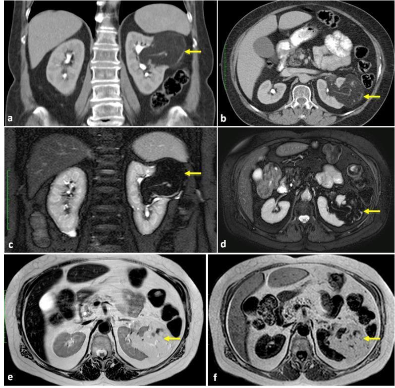 TRATO GENITOURINÁRIO: (Lesões do parênquima renal)