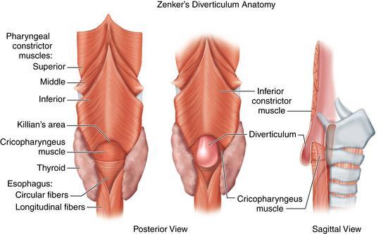 TRATO GASTRINTESTINAL: (SEED) Doenças Esôfago 1) Divertículos: Zenker (faríngeo): mais