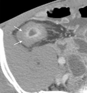 TRATO GASTRINTESTINAL: Doenças Jejuno e íleo EnteroCT x