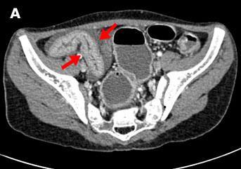 TRATO GASTRINTESTINAL: Doenças Jejuno e íleo EnteroCT x