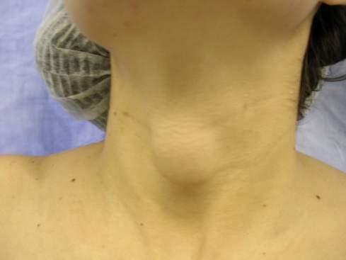 CIRURGIAS NO PESCOÇO 1. Tireoidectomia 2. Exérese de glândula salivar 3.