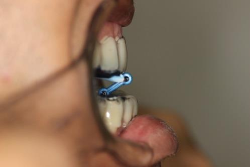 O dispositivo odontológico é indicado para o tratamento do ronco e de apneias leves ou moderadas com indicação médica.