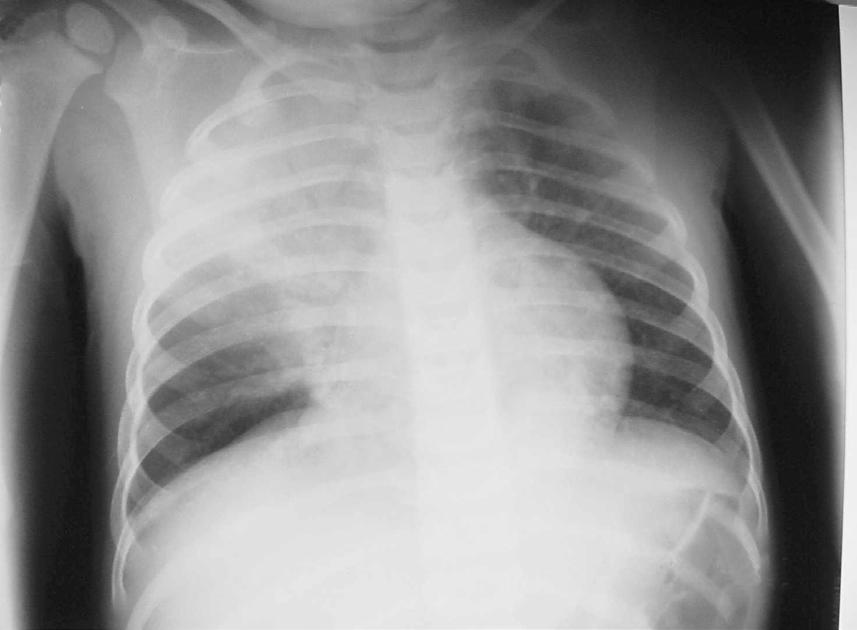 Figura 1 Consolidação alveolar Fonte: Radiografia pertencente ao Serviço de Pneumologia do Instituto de Puericultura e Pediatria Martagão Gesteira da Universidade Federal do Rio de Janeiro (2018).