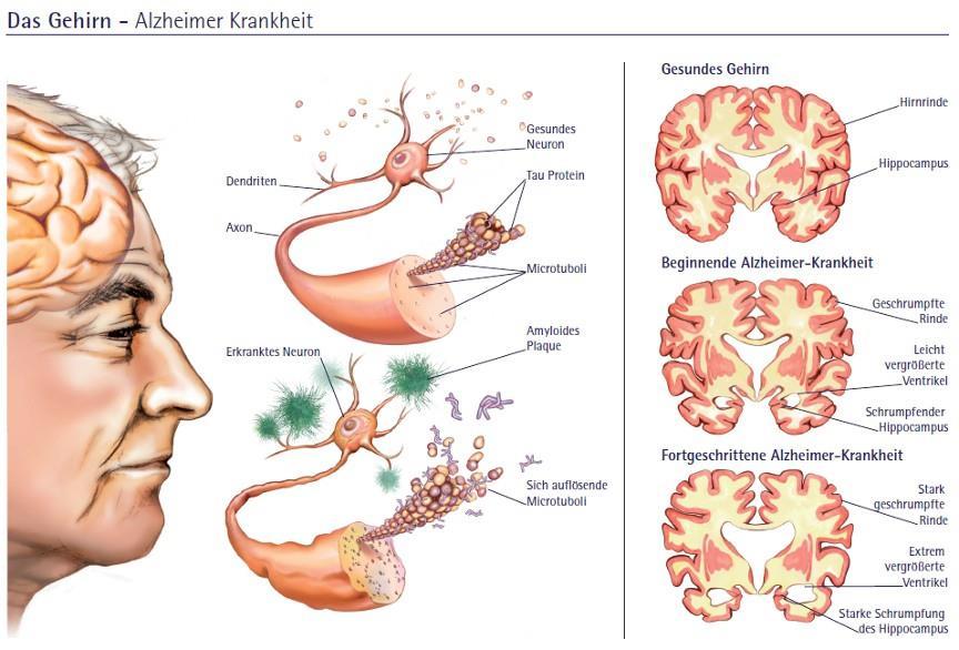 Emaranhados Neurofibrilares As proteínas Tau hiperfosforiladas agregam-se, formando os emaranhados