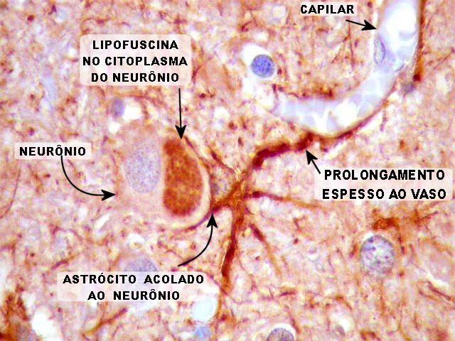 Acúmulo Oxidativo Acúmulo passivo de alterações a) Devido ao acúmulo de moléculas danificadas por radicais livres: acúmulo de radicais livres gera acúmulo de lipofucsina nas células.