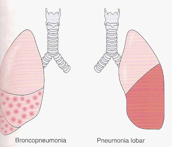 Pneumonia Pode ser definida, de forma ampla, como qualquer infecção