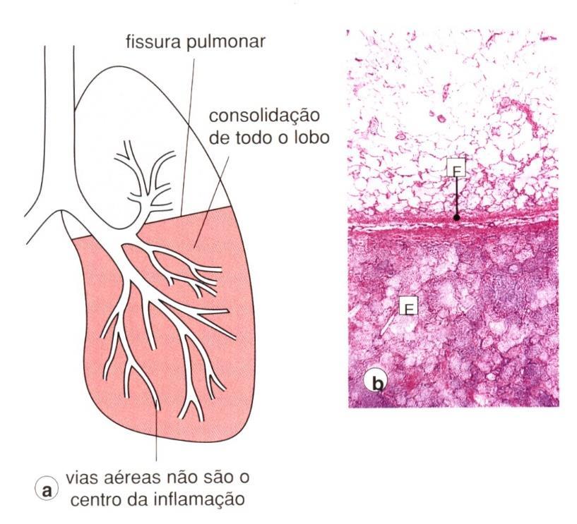 O pus pode estar presente nos bronquios perifericos e a complicacao comum e o