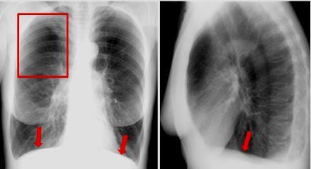 Enfisema pulmonar Dilatação dos espaços aéreos distais aos bronquíolos terminais com