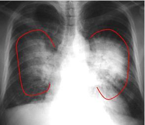 Edema pulmonar agudo