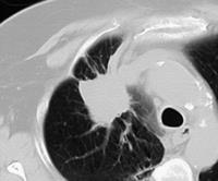 Tumor de pulmão Características do nódulo