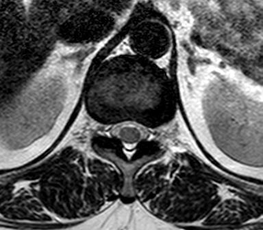 vertebral Medula espinhal