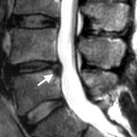 Ligamento interespinhoso Conecta os processos espinhosos Se