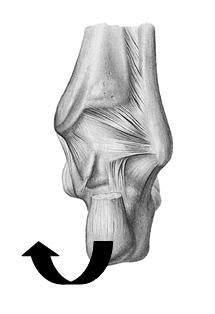 O calcâneo está anterior e sua interlinha articular lateral com o talus está aberta e a medial está comprimida. Paciente geralmente refere dor ao caminhar sobre a parte interna do pé.