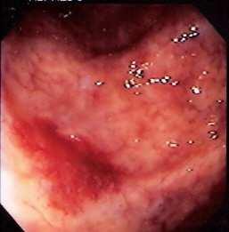 Angiodisplasia na mucosa do cólon antes da