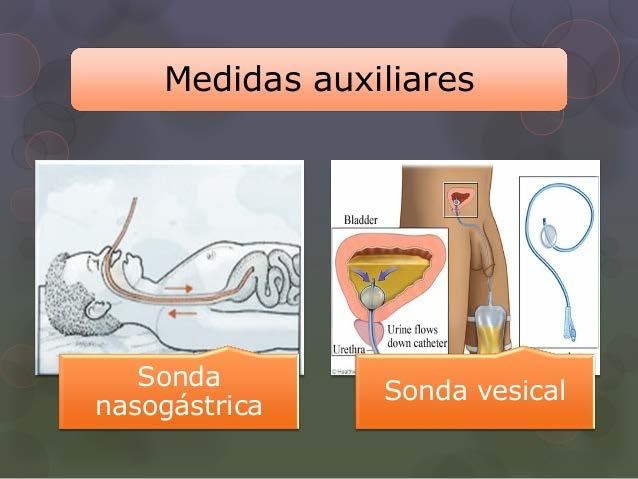 Atendimento à vítima de trauma no abdome Sondagens: SNG: descomprimir o estômago antes de realizar o LPD, remover conteúdo gástrico evitar risco de aspiração.