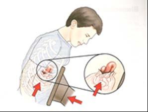 Classificação e mecanismo das lesões abdominais Trauma abdominal fechado: ocorre quando há