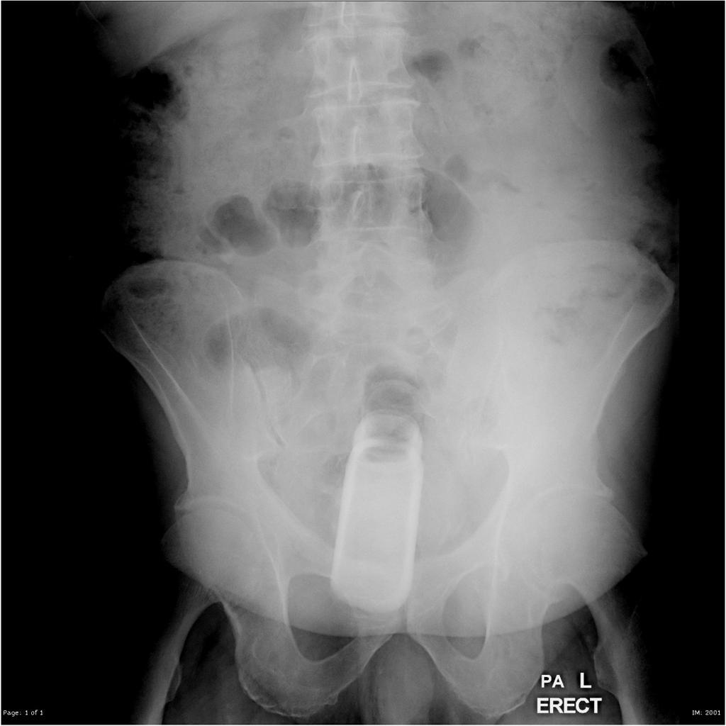 Empalamento Corpos estranhos introduzidos na vagina, ou no reto, podem penetrar a cavidade abdominal pela lesão desta estrutura com grave repercussão.