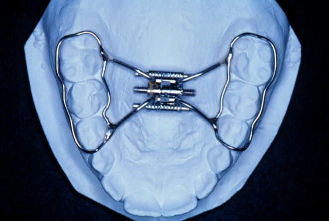 0,9mm), envolvendo as faces vestibulares e linguais dos dentes