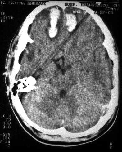 Contusão cerebral e hematoma intraparenquimatoso Comprometimento da superfície cerebral com vários graus de hemorragia petequial, edema e destruição tecidual.