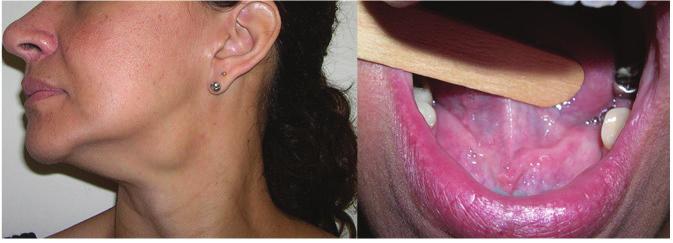 Após a paciente relatar a falta de sensibilidade em região do soalho bucal, um ponto simples de reparo foi confeccionado com fio de seda 3-0 e agulha 3/8 triangular (Ethicon Somerville -Nova Jersey
