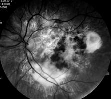 55 Fibrose sub-retiniana (cicatriz disciforme)