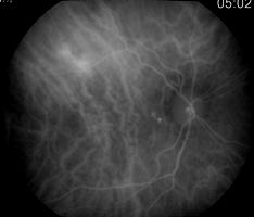 4.122 Vasculopatia coroideia polipoidal idiopática, com descolamento seroso retina (OCT) Drusens cuticulares Também chamados drusens laminares