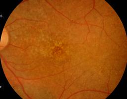 AF. Visualização de mais lesões do que na retinografia. DIAGNÓSTICO DIFERENCIAL: Distrofia pseudoviteliforme do adulto. EVOLUÇÃO: Prognóstico satisfatório, na ausência de NVSR associada.