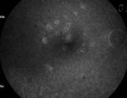 Fig. 4.175 Edema macular focal, por Retinopatia diabética (Retinografia) Fig. 4.176 Edema macular focal, por Retinopatia diabética (Anerítica) Fig. 4.177 Edema macular focal, por Retinopatia diabética (AF) o Difuso Espessamento retiniano difuso, que pode estar associado a alterações cistóides.