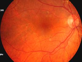 ETIOLOGIA: Após cirurgia da catarata, doença vascular retiniana,