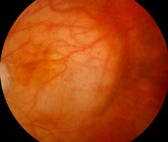 Característicos os remanescentes pigmentares, a atrofia do EPR da fóvea e o descolamento seroso retiniano
