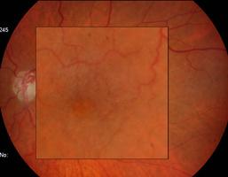 aumento da espessura retiniana (OCT). Fig. 4.