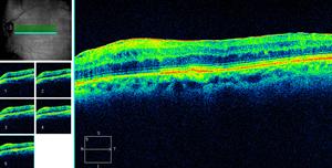 distorção dos vasos retinianos (Retinografia).