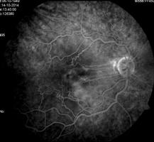 da aderência vítreo-macular, na qual a hialóidea posterior é parcialmente está parcialmente descolada da retina, mas permanece aderente ao centro da fóvea. Surge habitualmente em idade adulta.