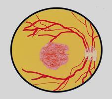 Neuroretinopatia macular aguda Rara. Idiopática. Uni ou bilateral. Afecta tipicamente mulheres saudáveis entre os 10 e os 30 anos. Prodromo pseudogripal. Autolimitada.