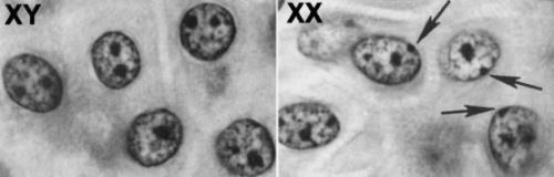cromossomo X com a maioria dos genes desligados ou inativos (hipótese de Lyon). Essa inativação, ocorre ao acaso, no início do desenvolvimento do embrião.