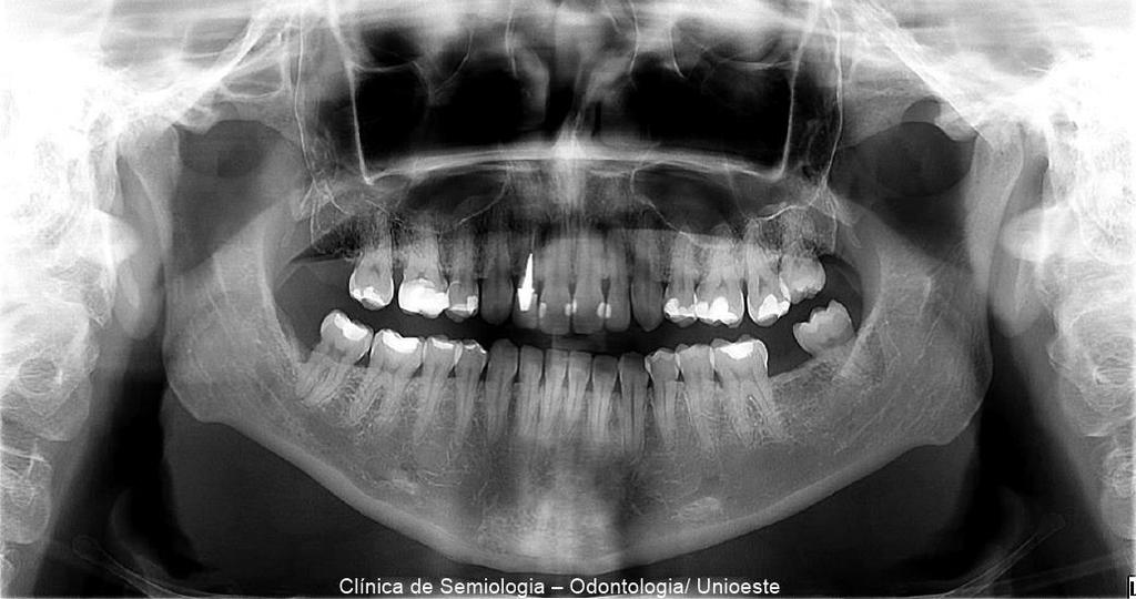 rebordos alveolares de maxila e mandíbula.