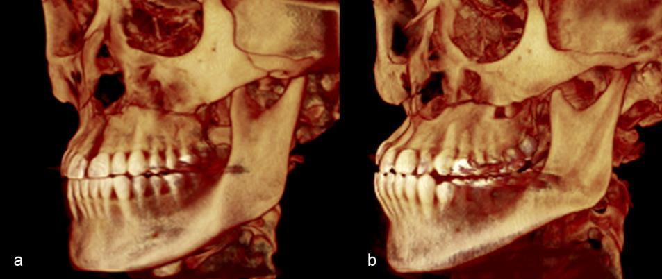 C a p í t u l o 1 46 A B Figura 1 - Reconstrução volumétrica das TCFC de pacientes submetidos à ERMAC realizadas com duas osteotomias da parede lateral de maxila.