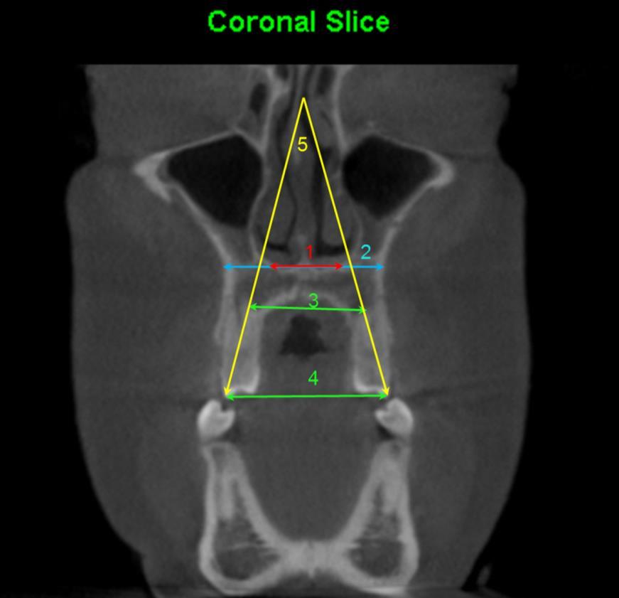 C a p í t u l o 1 49 Figura 4 - Medidas realizadas na região anterior da maxila ao nível dos primeiros pré-molares superiores: (1) Largura do assoalho nasal: medida a partir da porção mais inferior