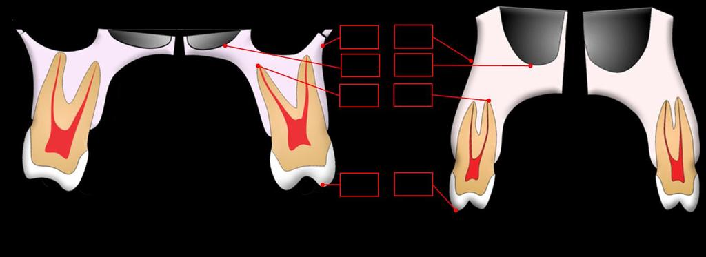 C a p í t u l o 1 55 inter-radicular apresentou baixa correlação quando medida nos primeiros molares e não se encontrando correlação entre a distância radicular dos primeiros pré-molares e a abertura