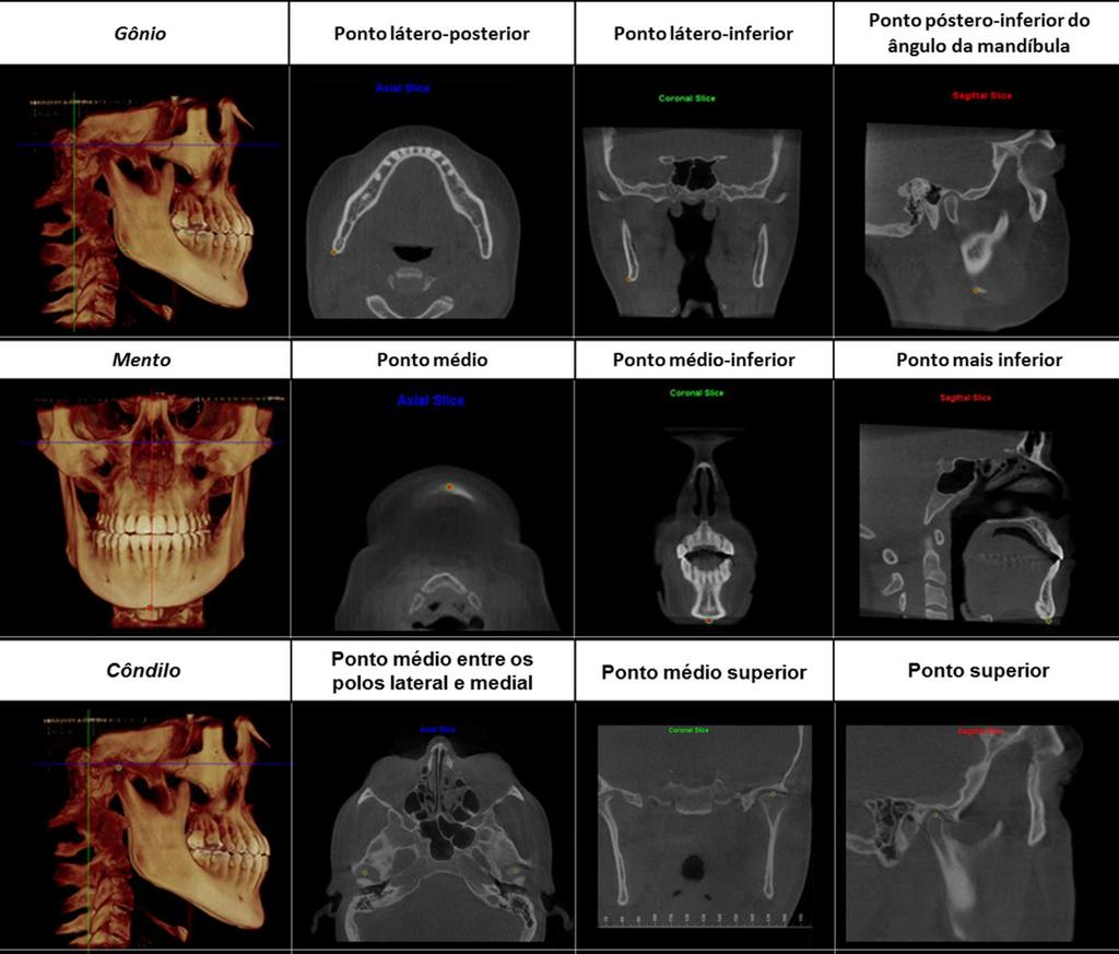 C a p í t u l o 2 73 Figura 2 - Definição dos pontos anatômicos mandibulares na reconstrução volumétrica e nas reconstruções multiplanares de acordo com cortes axial, coronal e sagital.