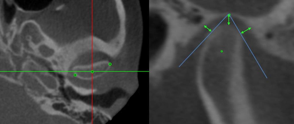 Espaço articular superior (EAS): distância do ponto mais superior do côndilo até a parede superior da fossa mandibular; 3.