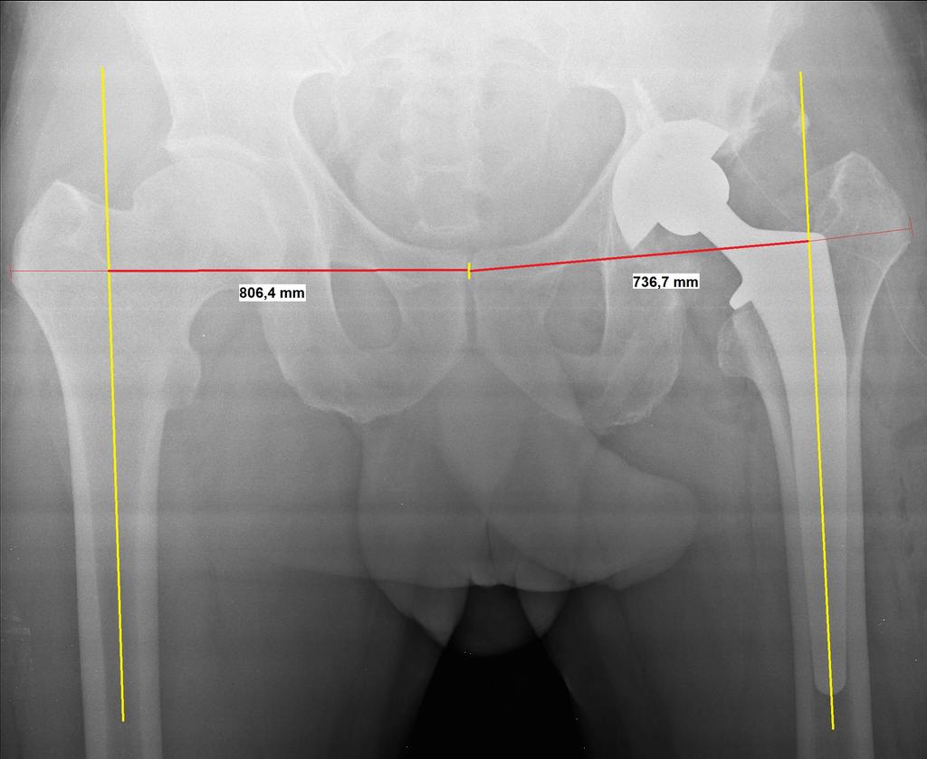 Em contrapartida, valores positivos obtidos desta subtração indicam ganho de offset femoral lateral em relação ao lado contralateral.