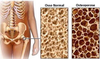 Deficiência de estrogênio; Uso de glicocorticóide oral; Alcoolismo;