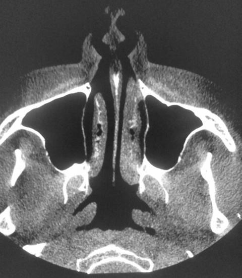 Tomografia por feixes cônicos vantagens e desvantagens Dose de radiação em