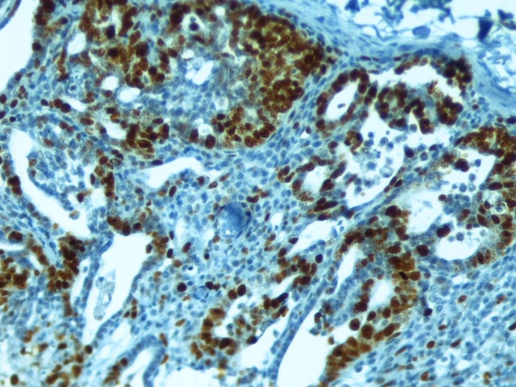 IMUNOEXPRESSÃO DA CASPASE-3 Tecido mamário normal Nas amostras de tecido mamário normal, verificou-se que a imunoreatividade à Caspase-3