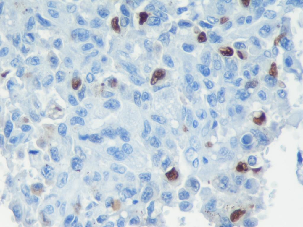 Neoplasias malignas Nos carcinomas avaliados verificou-se que a imunoreatividade à Caspase-3 variava de 0,4 a 7,7 células/campo, tendo-se registado um valor médio de 3,67 células/campo (±1,97DP).